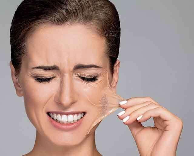 Chemical Peels