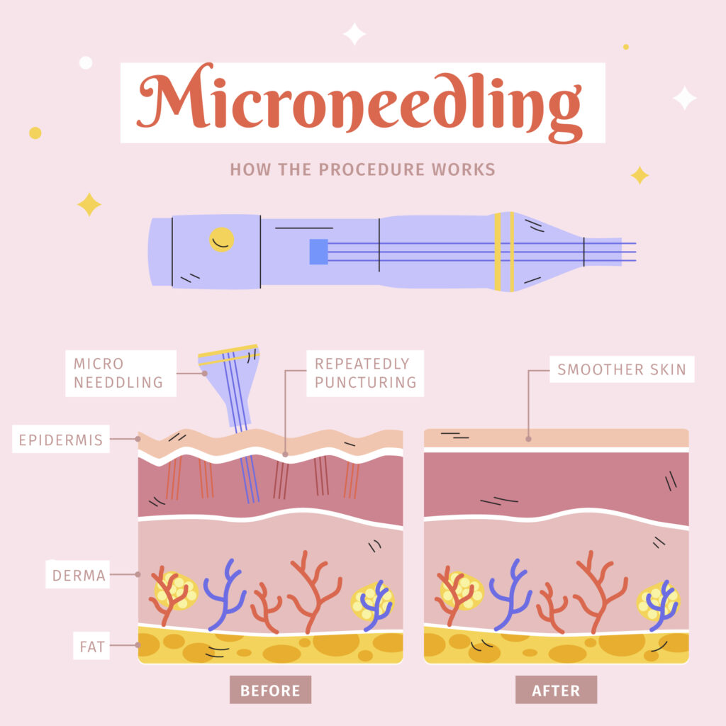 Micro needling - Derma Roller
