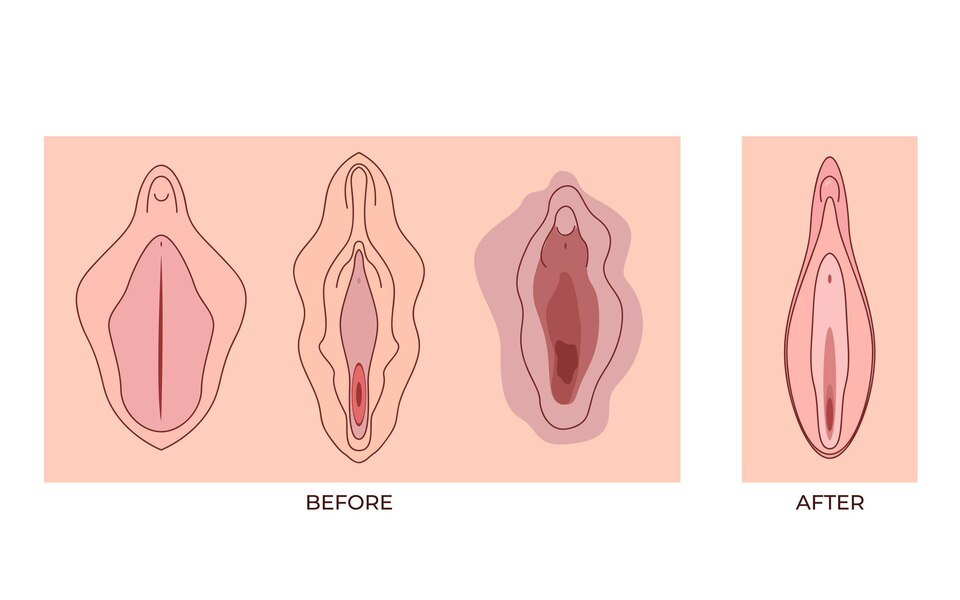 Vaginoplasty