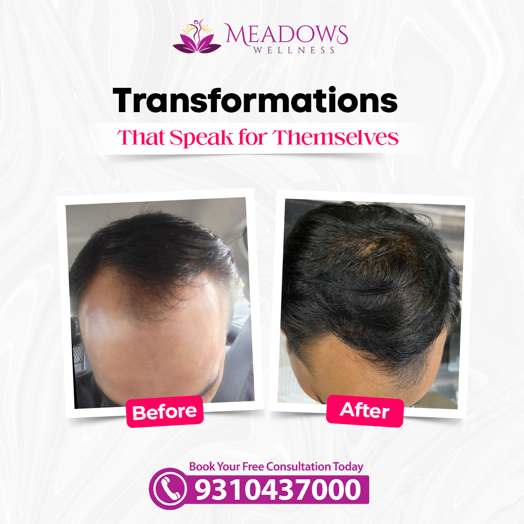 GFC Hair PRP
