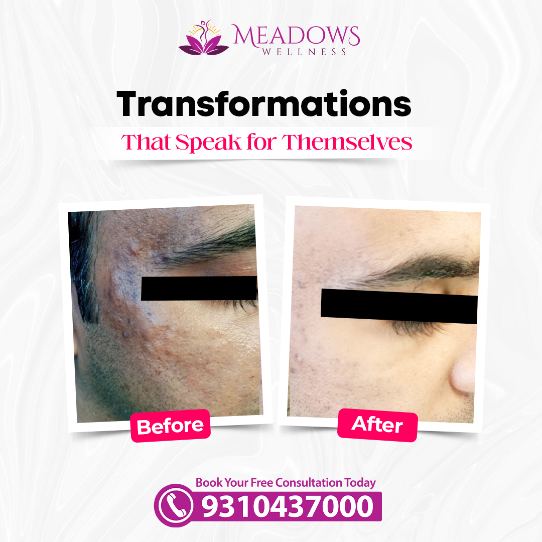 Pigmentation