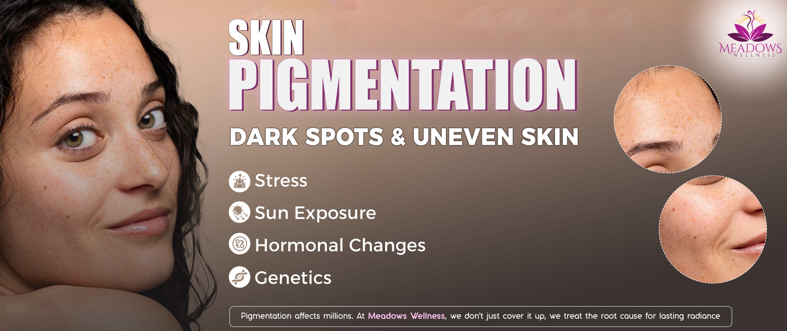 Skin Pigmentation