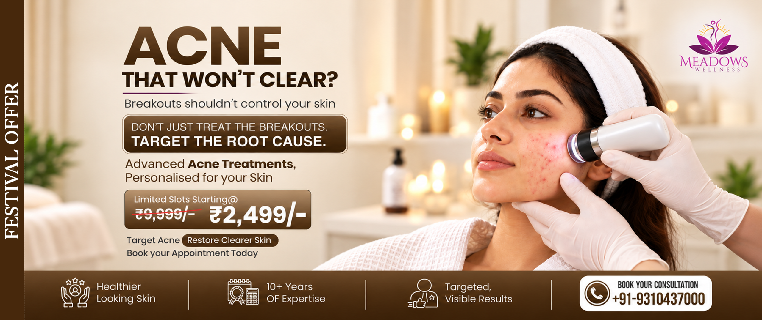 Acne Pigmentation