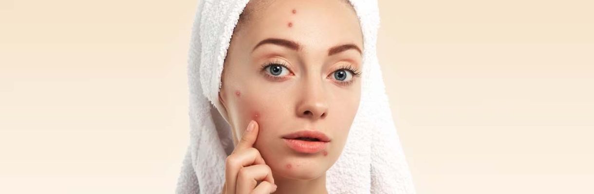 Tips-for-Acne-Prone-Skin-1
